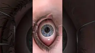 Cataract Surgery: 3d animation #eyesurgeon #cataract #cataracttreatment
