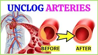3 Amazing Teas That Clean Your Arteries And Prevent Heart Disease