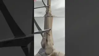 OPERASI PASANG PEN PATAH TULANG KAKI DISTAL || DUNIA KEPERAWATAN