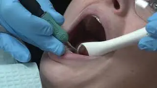 Purevac HVE System - Evacuation Device Comparison | Dentsply Sirona