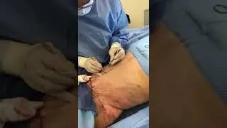 Tummy Tuck Surgery Part 6: Sculpting a Beautiful Belly Button