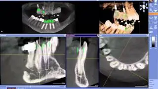 27 mental foramen