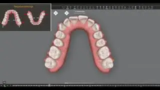Dr. Nimrod Dykstein- Case 1: class 2 div.2 with deep over-bite