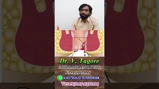 🔥 Piles Treatment Explained Clearly |  Laser Treatment | Dr. Tagore &ndash; Vizag Advanced Surgical Centre