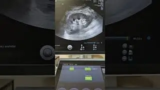 Острое паренхиматозное заболевание почек || Ультразвуковое исследование