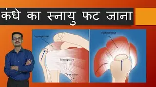 कंधे के अंदर रोटेटर कफ टीयर का इलाज  Rotator cuff Tear Hindi