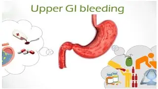 Emergency Case - DCLD with Upper GI bleed - presenting Complain _investigation - Treatment 