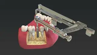 myplant dental | Implant Insertion Motorized with Handpiece Manual Torque Measurement