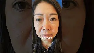PDO Thread Lift Before and After, PCH MedSpa, Orange County