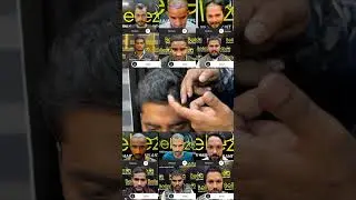 Best hair transplant in Delhi - Belleza Rohini