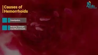 Piles Explained | Causes, Symptoms & Treatment