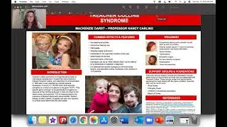 Treacher Collins Syndrome - MacKenzie Darst