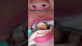 Ultrasonic dental cleaning removing tartar in patient with periodontitis.