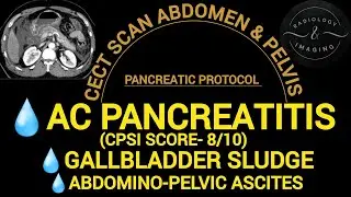 CT Scan Abdomen Contrast Enhanced to rule out Pancreatitis and any other Abdomino-Pelvic Pathologies
