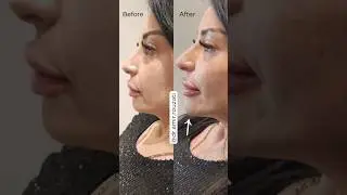Our Clinic is Proud to be among the First in Canada to offer RESTYLANE Shape for CHIN.#botoxfillers