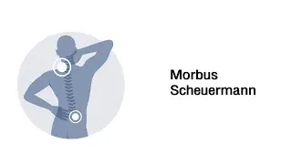 Morbus Scheuermann - Erkrankungen des Bewegungsapparates