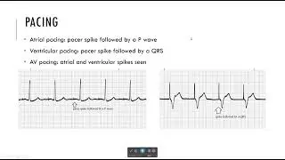 Third degree block and Pacemakers