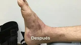 CADA PACIENTE CON CHARCOT MARIE TOOTH ES UN MUNDO Vídeo