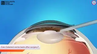 Can Cataract come back after surgery ?