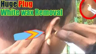Infected Chunky White Earwax Removal Video / Large Plugs Earwax Removal / Satisfying Ear Cleaning