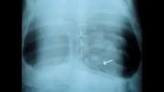 New drug-delivery capsule may replace injections