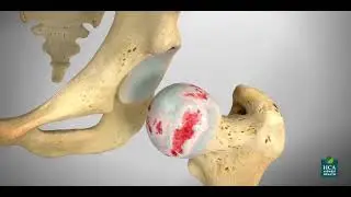 Understanding Your Hip Replacement Surgery