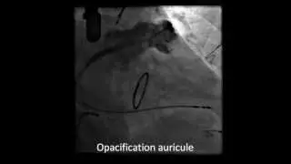 Left Atrial Appendage Closure Technology Watchman.  C Durand, A Durand-Dubief, H Poty, C Mazet. Lyon