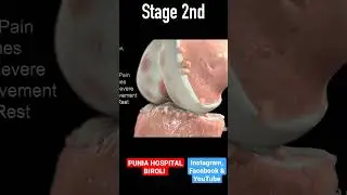 Osteoarthritis 3D Animation #share #trending #doctor #shortfeed #reels #jointpain #osteoarthritis
