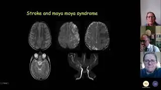 Types of Stroke in Paediatric Sickle cell patients