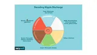 case discussion-nipple discharge