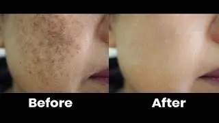 Raaga platinum facial kit // How to remove pigmentation //