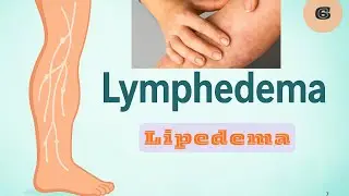 6 Lymphedema vs Lipedema | الفرق اللي لازم كل دكتور علاج طبيعي يعرفه