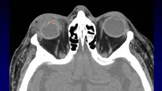 Imaging of the Eye and Orbit, Part 3