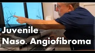 Neuroangiography by Dr. Alex Berenstein - Angiofibroma of Nasopharynx - Mount Sinai Hospital