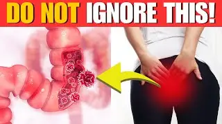 early warning signs of colon cancer you should not ignore!