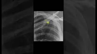 Shoulder Trauma - YouTube Short #sportsinjury#shorts #fracture