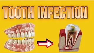 TOOTH 🦷 INFECTION IN 3D ANIMATION BIOBUZZ LIKE AND SUBSCRIBE FOR MORE INFORMATION #dentist