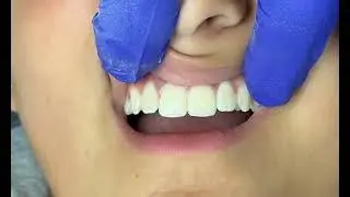 Ormco EtchFree Bonding 