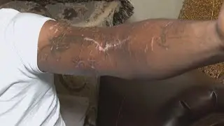 Louisiana dog attack survivor speaks out after owners’ arrest related to discovery of human remains
