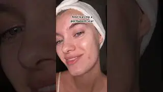 Rule of popping pimples without scarring🫶🏻💖 it will reduce the potential damage✨ #acne #pimple