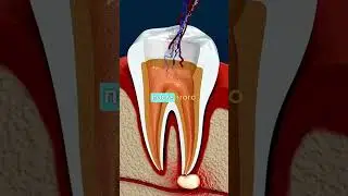 Удаление НЕРВА Зуба 🦷😱 (как происходит) ✨ #shorts #факты #удаление #зубы #интересно
