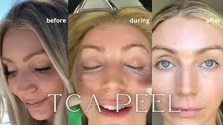 TCA PEEL | PROCEDURE AND RECOVERY PROCESS | BEFORE AND AFTERS | Q&A