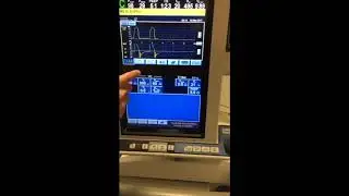 Identifying and Treating AutoPEEP