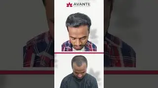 Great Hairline and good Extraction 4 Months Hair Transplant Result #shorts #hairtransplant ‬