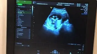 Reciprocal IVF Pregnancy: House Hunting and 12 week Ultra-Sound!