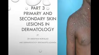 PRIMARY AND SECONDARY SKIN LESIONS ,CONFIGURATION AND DISTRIBUTION OF SKIN DISEASES#education #duet