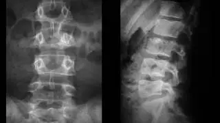 DxI y Dolor lumbar