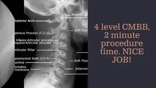 2 Minute Cervical Medial Branch Block