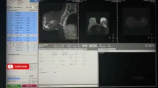 MRI Breast contrast with perfusion post processing. #dynamicstudy #postprocessing #3.0T