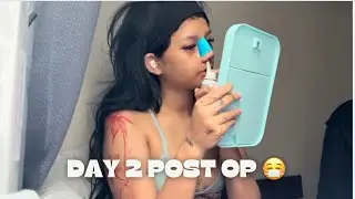 DAY 2 POST OP - CLEANING MY NOSE (RHINOPLASTY JOURNEY) 🥰 |ERICA AHERN